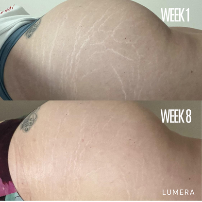 Lymphatic Drainage & Anti-Cellulite Massager