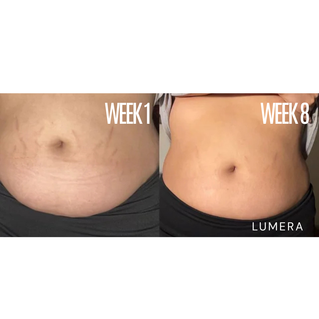 Lymphatic Drainage & Anti-Cellulite Massager