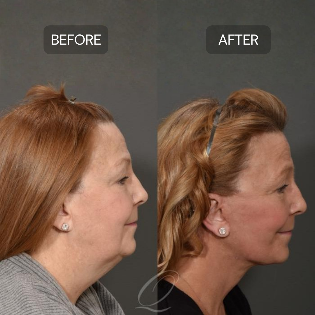 Lymphatic Support Herbal Drops