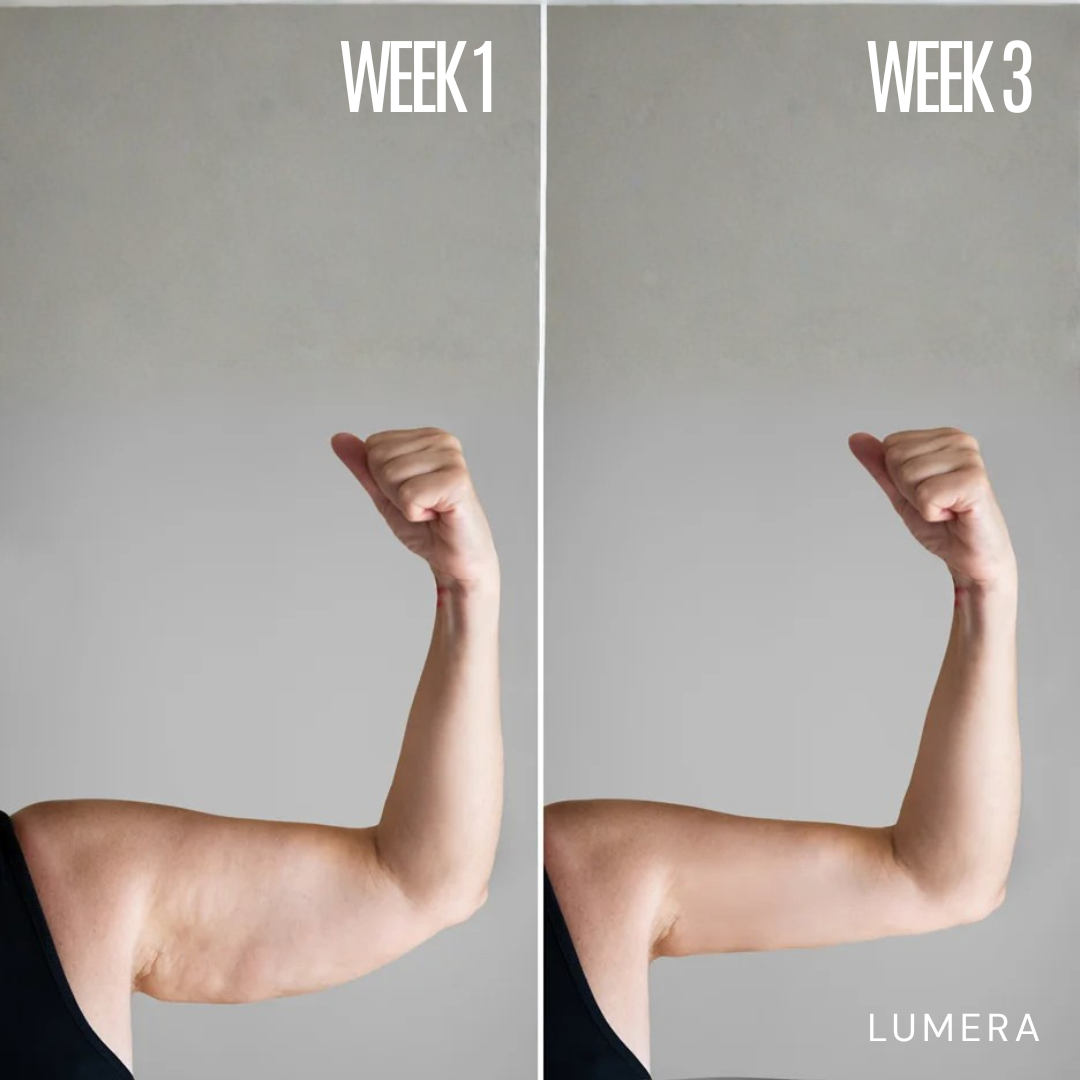 Lymphatic Drainage & Anti-Cellulite Massager