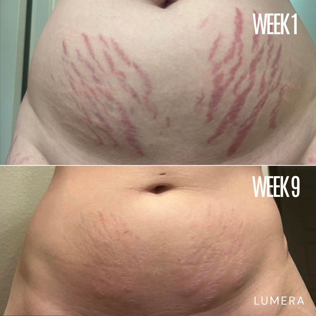 Lymphatic Drainage & Anti-Cellulite Massager