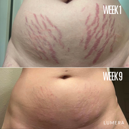 Lymphatic Drainage & Anti-Cellulite Massager