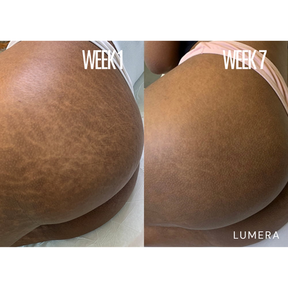 Lymphatic Drainage & Anti-Cellulite Massager