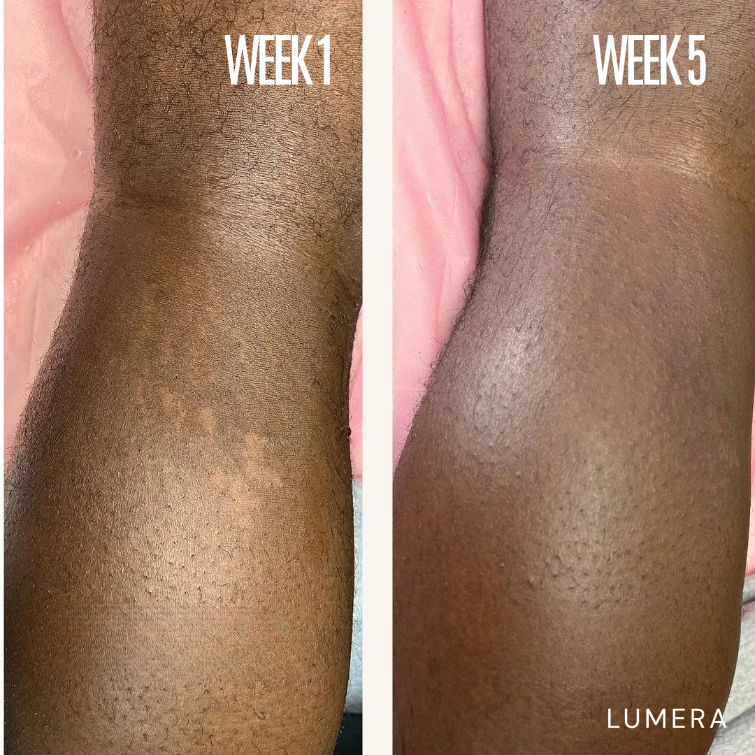 Lymphatic Drainage & Anti-Cellulite Massager